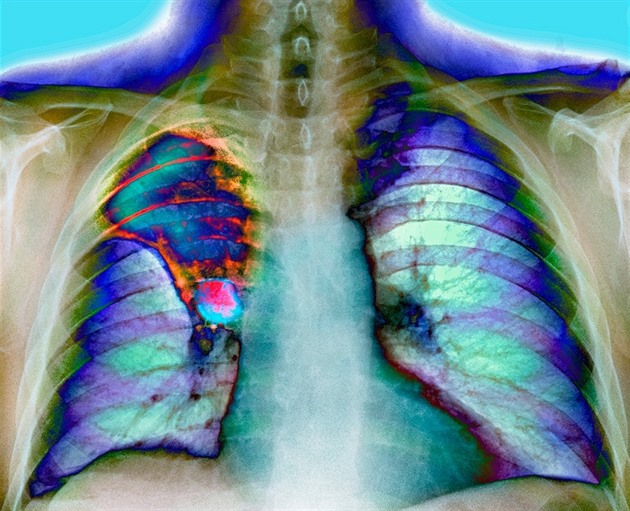 Sportoval, žil zdravě a nekouřil. Přesto onemocněl rakovinou plic