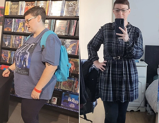 Žena měla v břiše stovky polypů, po jejich odstranění zhubla třicet kilo