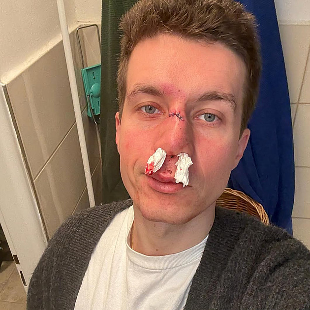 Modlitba za zdraví skončila na ledovce rozbitým obličejem. Herec Krejčík musel na pohotovost